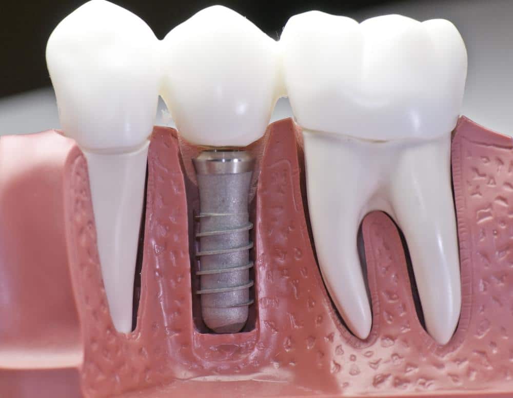 dental-implants-mt-pleasant-sc
